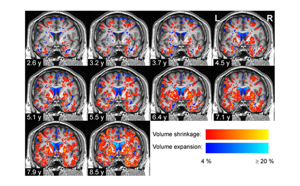 How do the volumes of brain regions change in Parkinson’s disease? Image credit: Human Brain Project